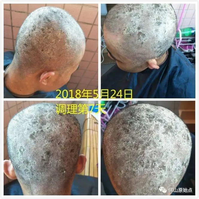 原始点调理严重牛皮癣及静脉曲张:84天完好如初 原始点调理严重牛皮癣及静脉曲张:84天完好如初