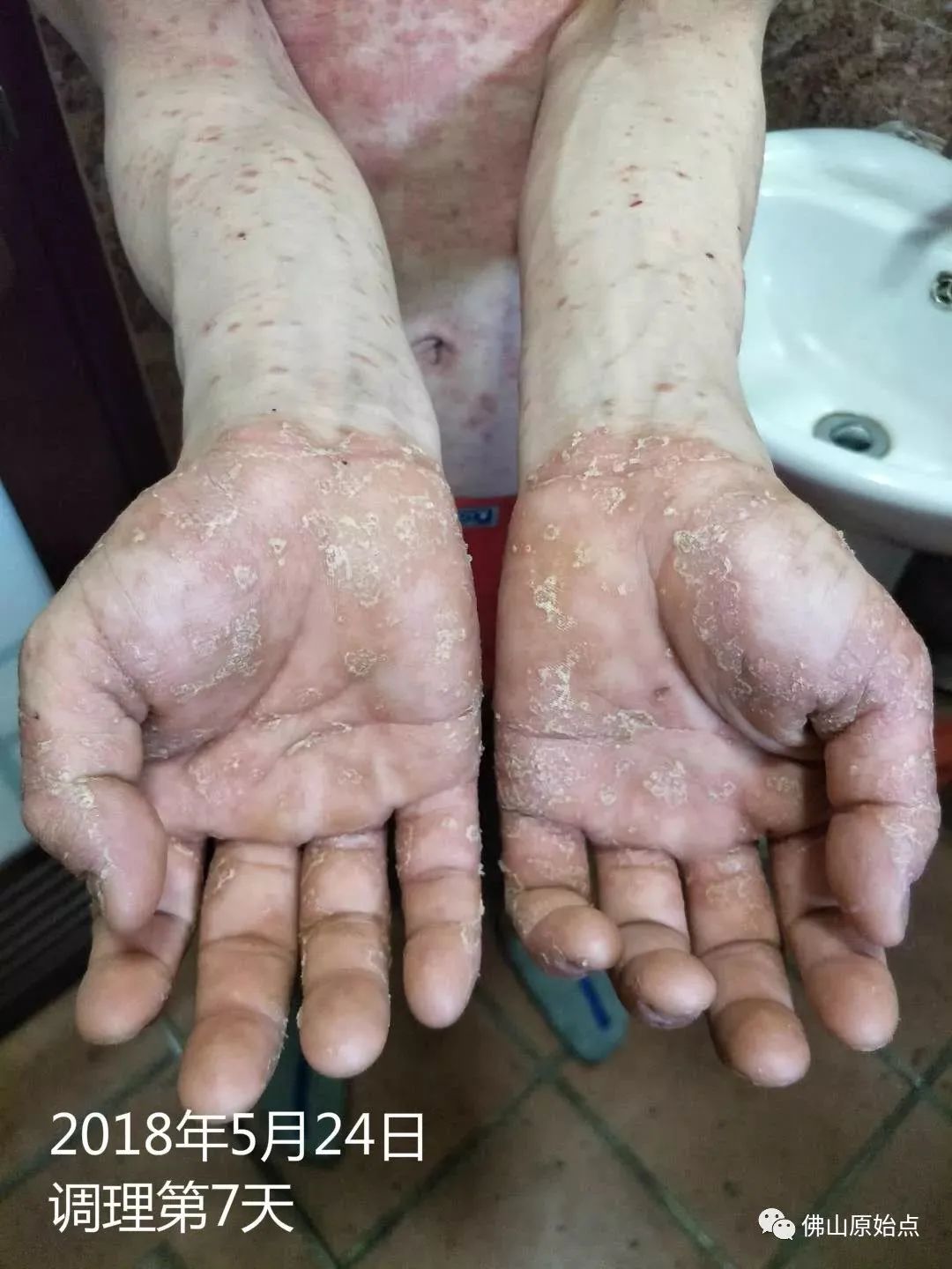 原始点调理严重牛皮癣及静脉曲张:84天完好如初 原始点调理严重牛皮癣及静脉曲张:84天完好如初