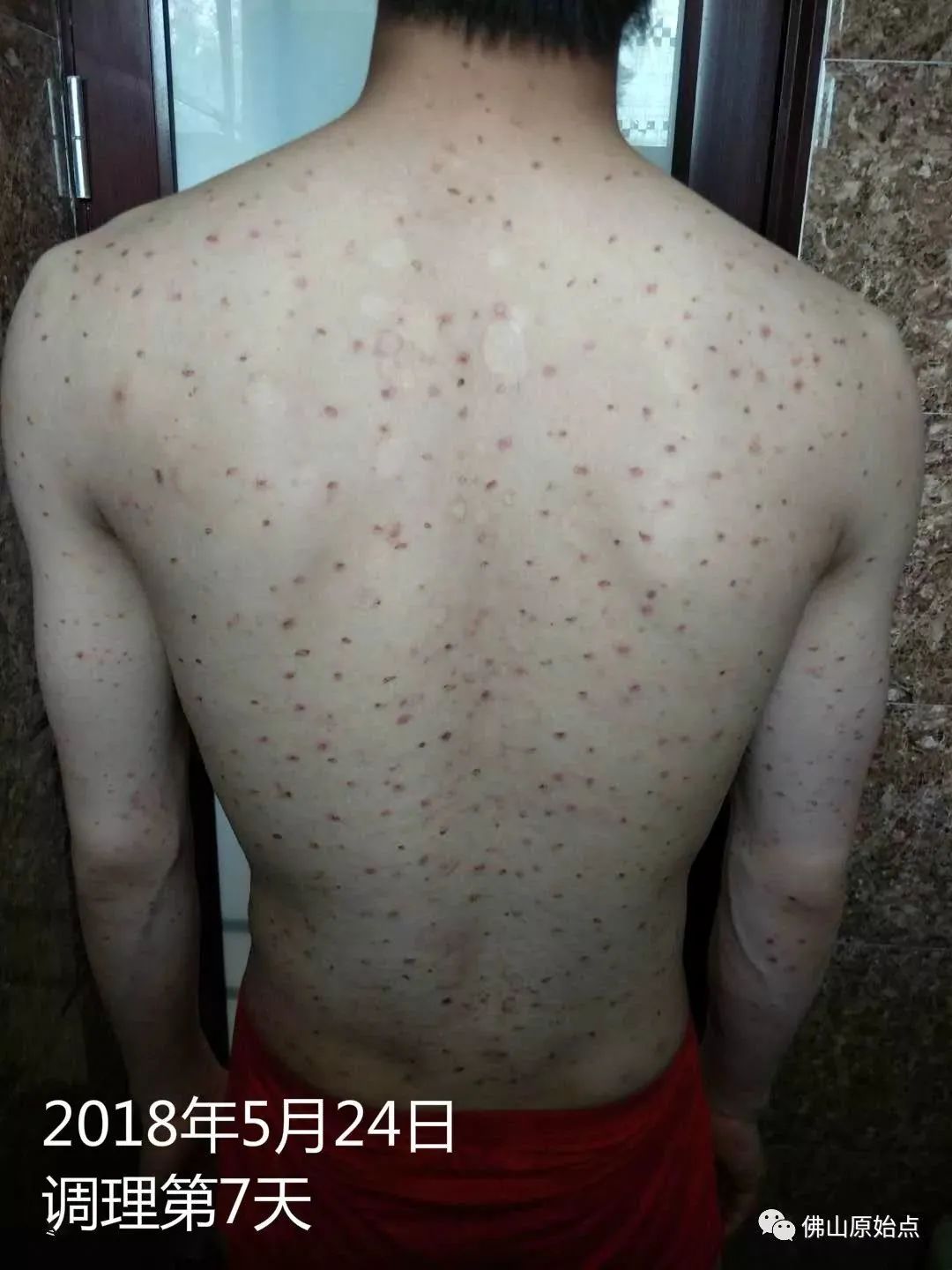 原始点调理严重牛皮癣及静脉曲张:84天完好如初 原始点调理严重牛皮癣及静脉曲张:84天完好如初