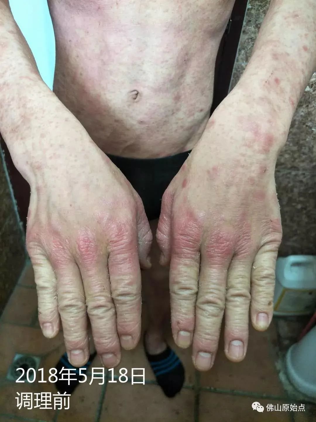 原始点调理严重牛皮癣及静脉曲张:84天完好如初 原始点调理严重牛皮癣及静脉曲张:84天完好如初