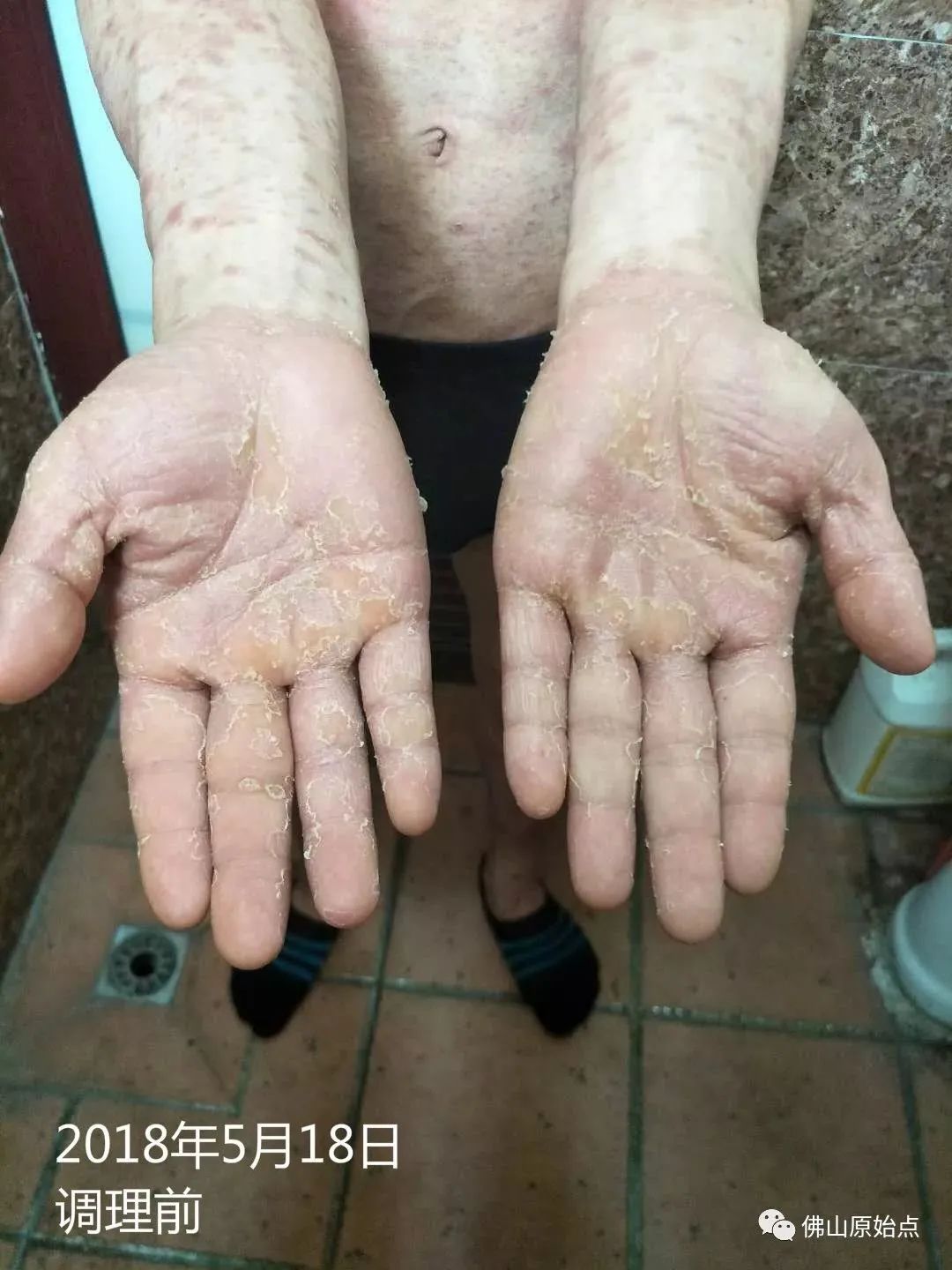 原始点调理严重牛皮癣及静脉曲张:84天完好如初 原始点调理严重牛皮癣及静脉曲张:84天完好如初