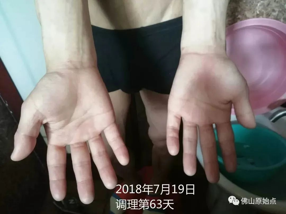 原始点调理严重牛皮癣及静脉曲张:84天完好如初 原始点调理严重牛皮癣及静脉曲张:84天完好如初