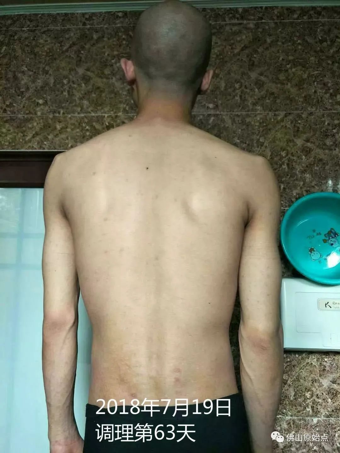 原始点调理严重牛皮癣及静脉曲张:84天完好如初 原始点调理严重牛皮癣及静脉曲张:84天完好如初