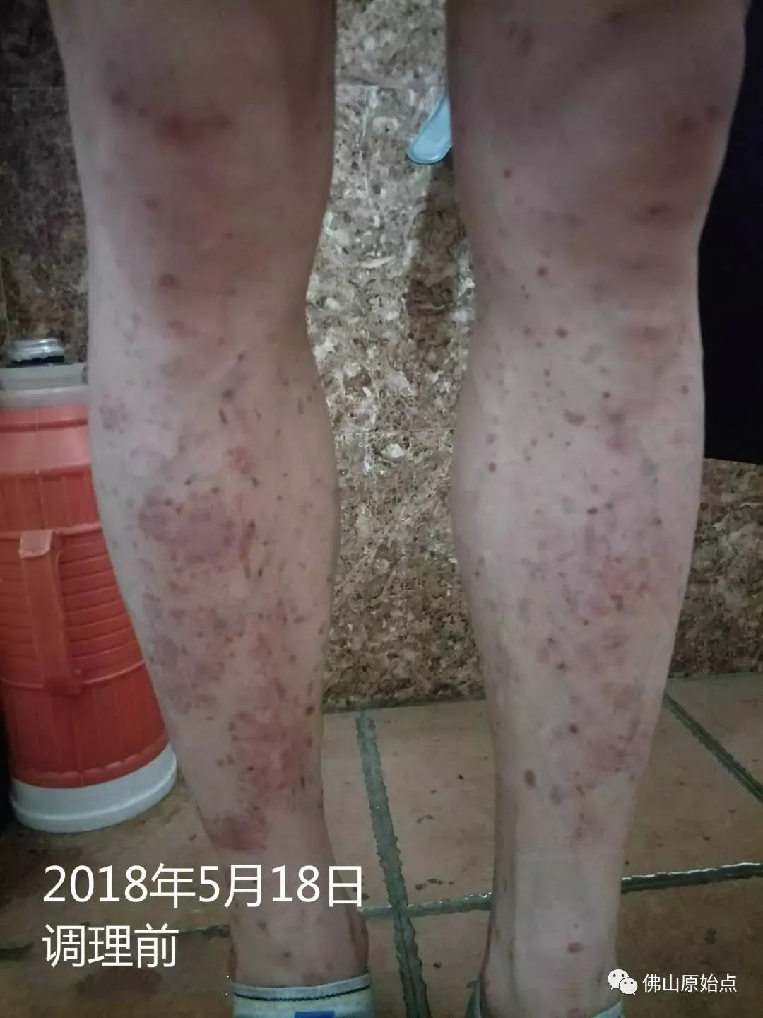 原始点调理严重牛皮癣及静脉曲张:84天完好如初 原始点调理严重牛皮癣及静脉曲张:84天完好如初