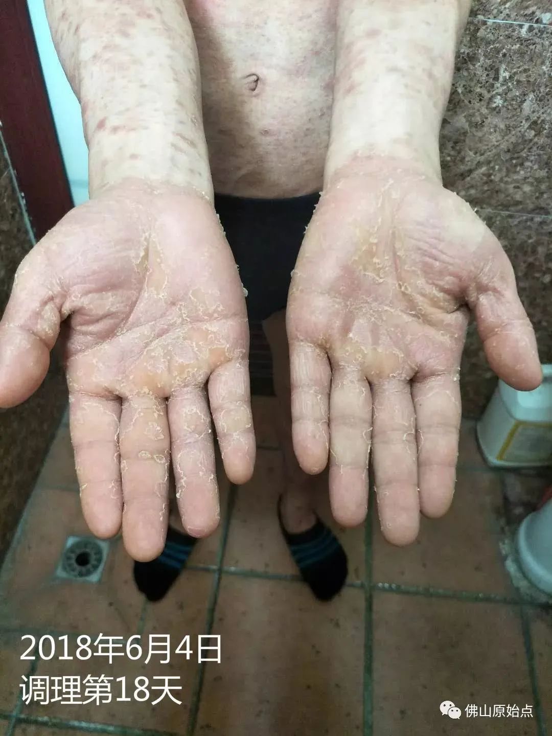 原始点调理严重牛皮癣及静脉曲张:84天完好如初 原始点调理严重牛皮癣及静脉曲张:84天完好如初