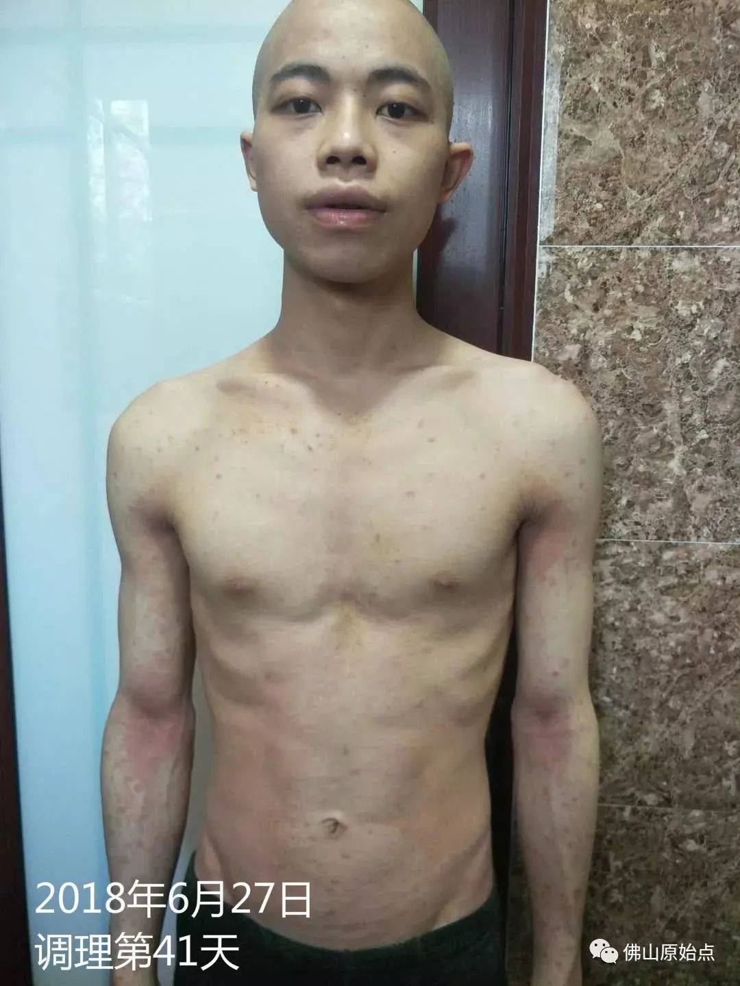 原始点调理严重牛皮癣及静脉曲张:84天完好如初 原始点调理严重牛皮癣及静脉曲张:84天完好如初