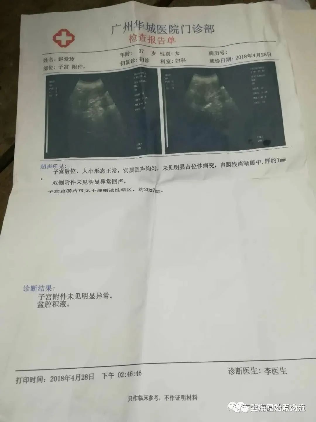 妇科病案例:阴道炎,宫颈炎,盘腔积液 妇科病案例:阴道炎,宫颈炎,盘腔积液