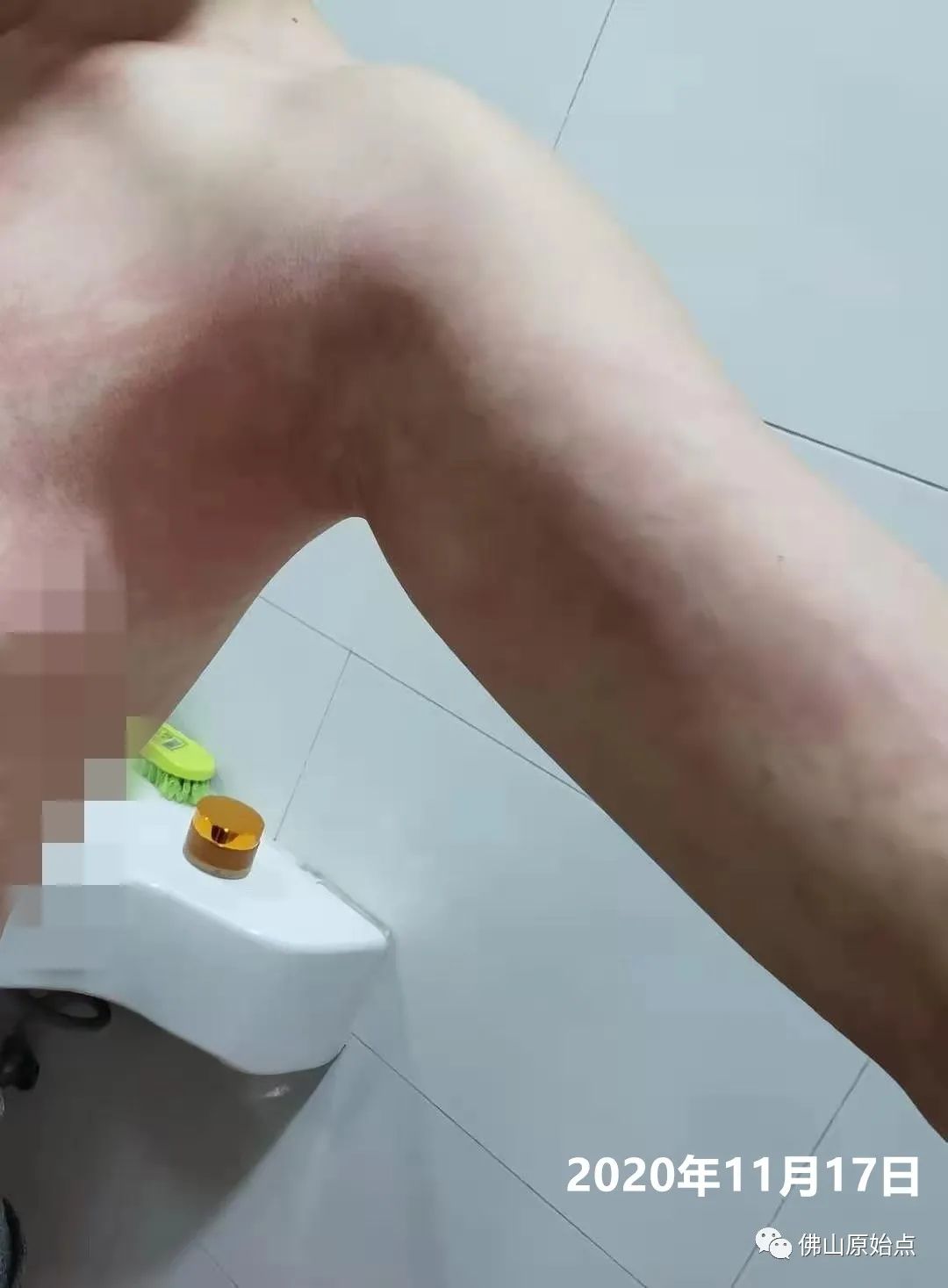 原始点调理红斑荨麻疹案例 原始点调理红斑荨麻疹案例