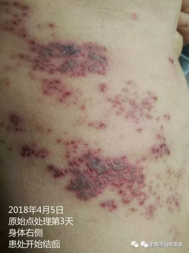 带状疱疹案例两则 带状疱疹案例两则