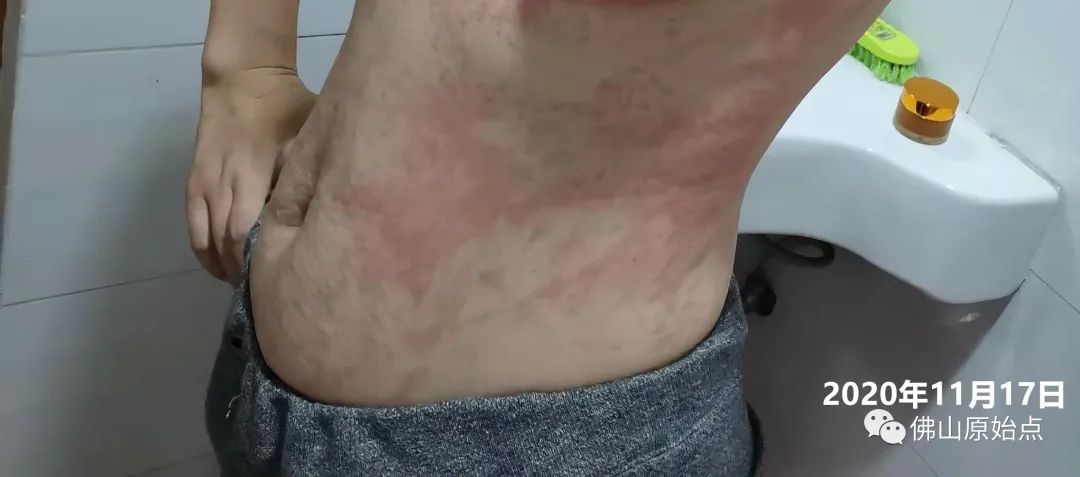 原始点调理红斑荨麻疹案例 原始点调理红斑荨麻疹案例