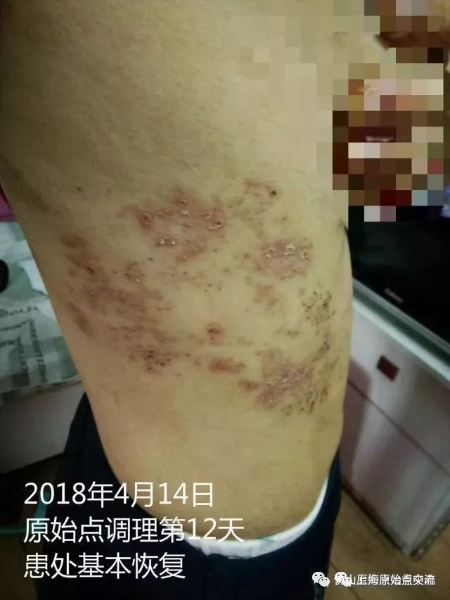 带状疱疹案例两则 带状疱疹案例两则