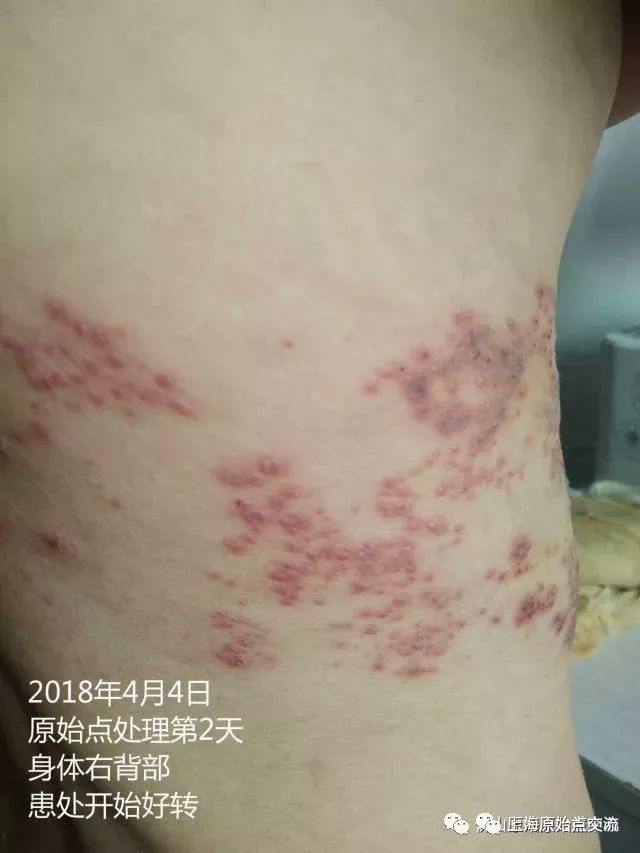 带状疱疹案例两则 带状疱疹案例两则