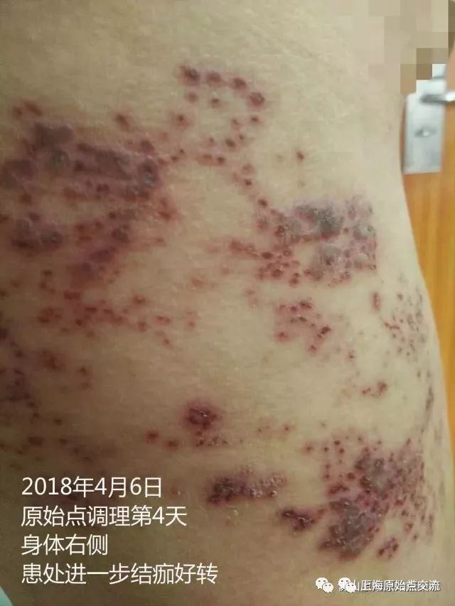 带状疱疹案例两则 带状疱疹案例两则