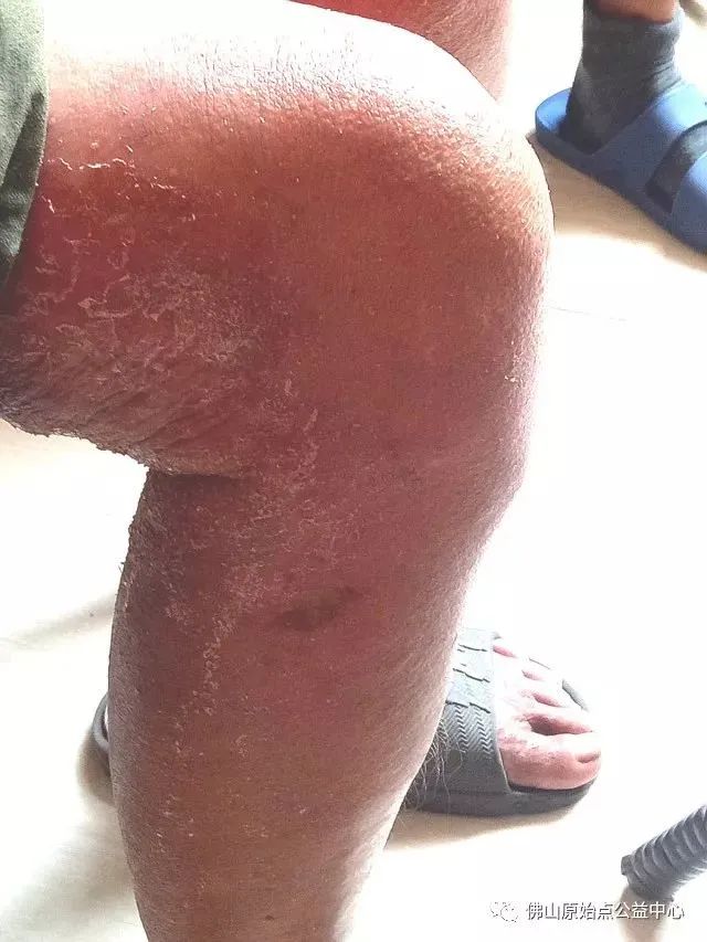 原始点调理全身肿胀溃烂:九个月,雨过天睛 原始点调理全身肿胀溃烂:九个月,雨过天睛