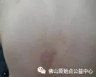 原始点调理九年史牛皮癣:二十天大变化 原始点调理九年史牛皮癣:二十天大变化