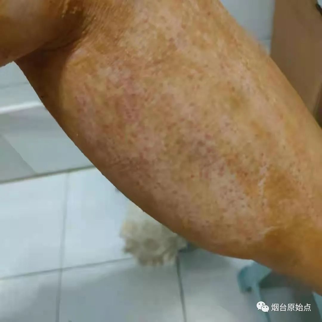 术后药物引起皮肤过敏案例 术后药物引起皮肤过敏案例