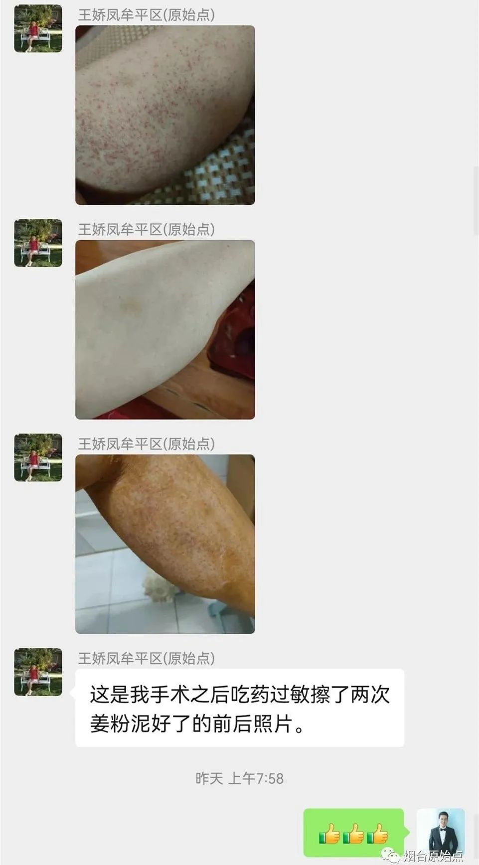 术后药物引起皮肤过敏案例 术后药物引起皮肤过敏案例