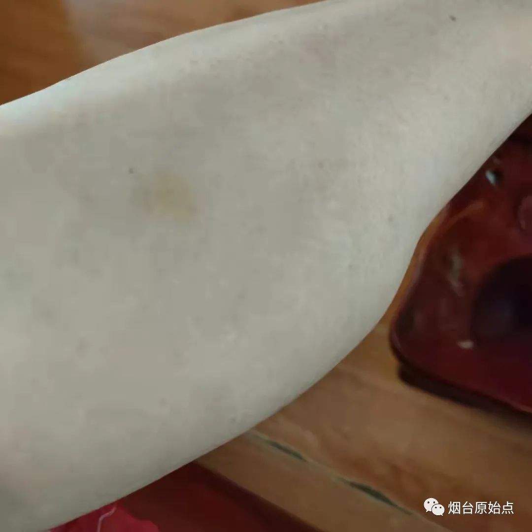 术后药物引起皮肤过敏案例 术后药物引起皮肤过敏案例