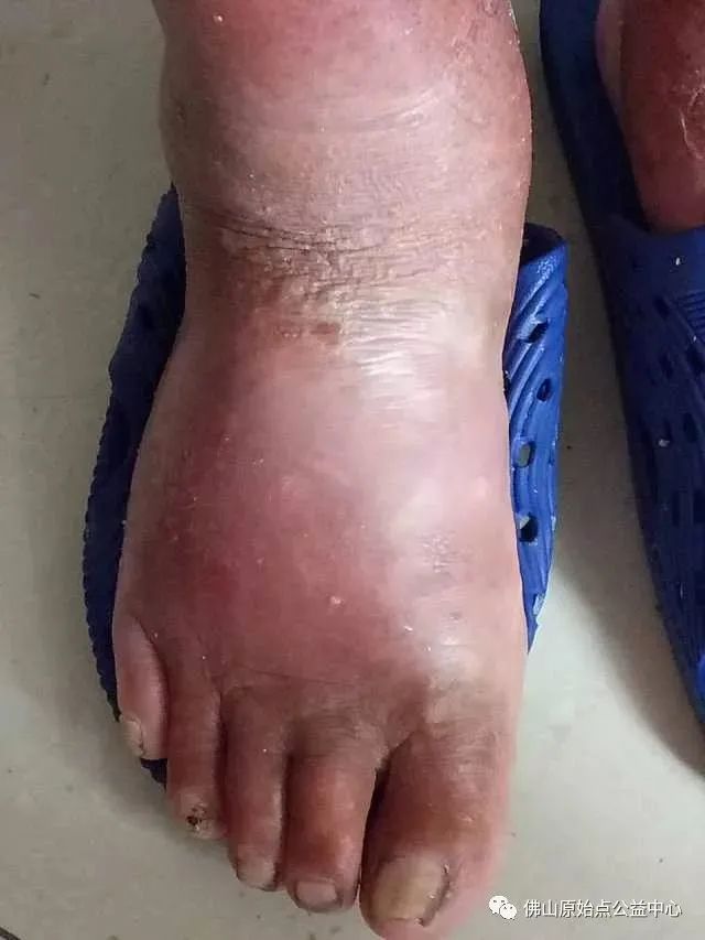 原始点调理全身肿胀溃烂:九个月,雨过天睛 原始点调理全身肿胀溃烂:九个月,雨过天睛