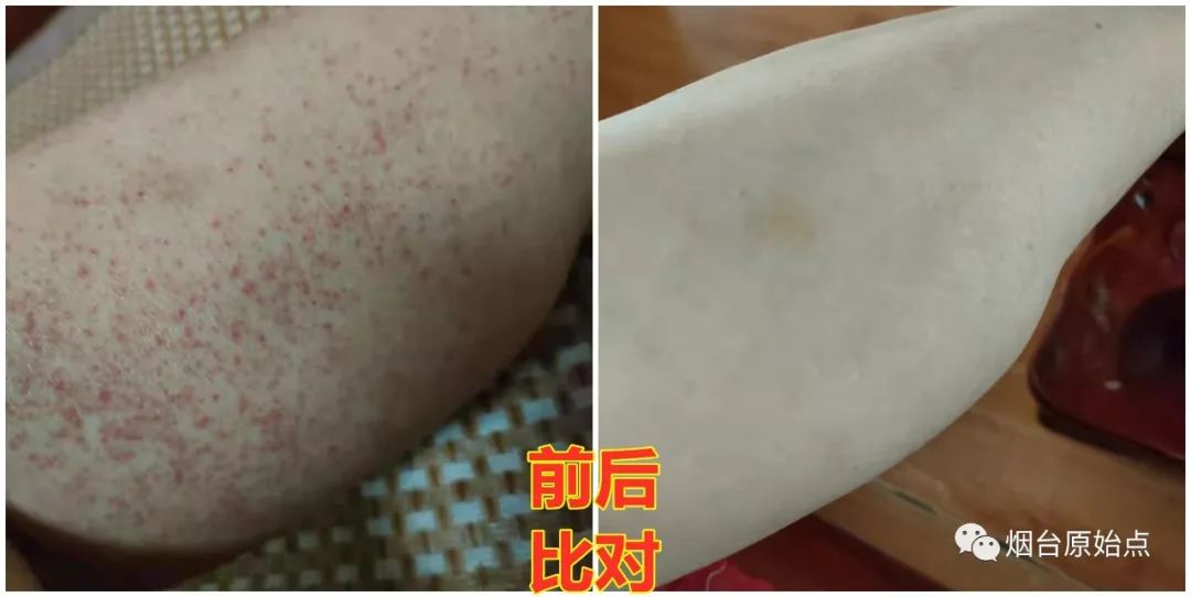 术后药物引起皮肤过敏案例 术后药物引起皮肤过敏案例