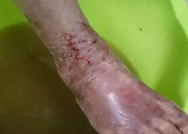 原始点调理全身肿胀溃烂:九个月,雨过天睛 原始点调理全身肿胀溃烂:九个月,雨过天睛