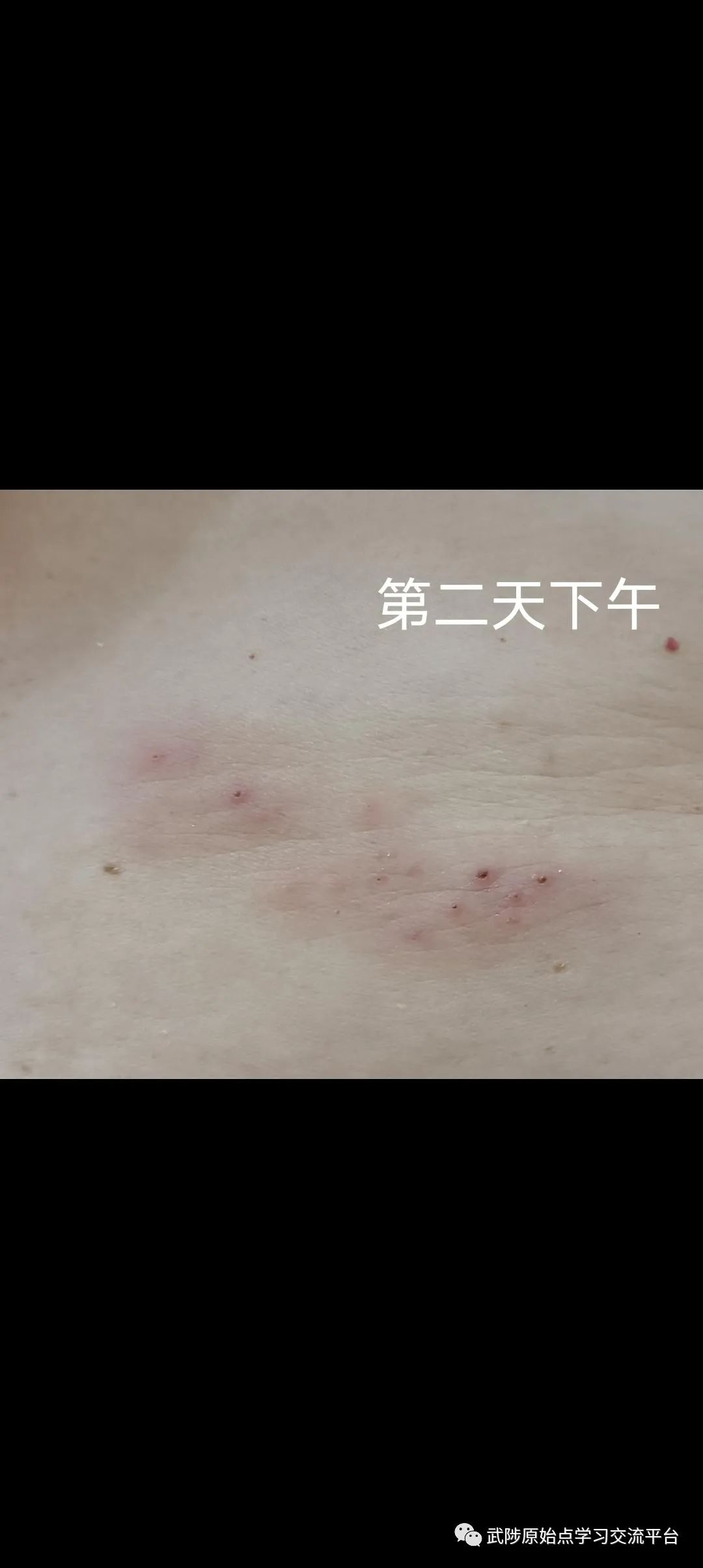 带状疱疹案例 带状疱疹案例