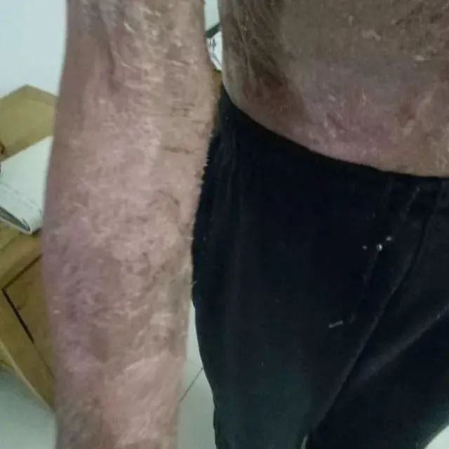 原始点调理全身肿胀溃烂:九个月,雨过天睛 原始点调理全身肿胀溃烂:九个月,雨过天睛