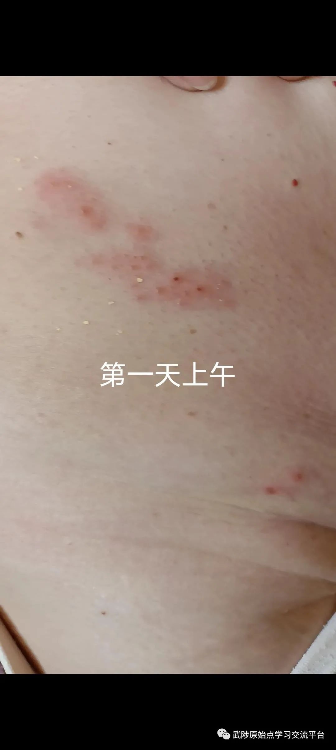 带状疱疹案例 带状疱疹案例