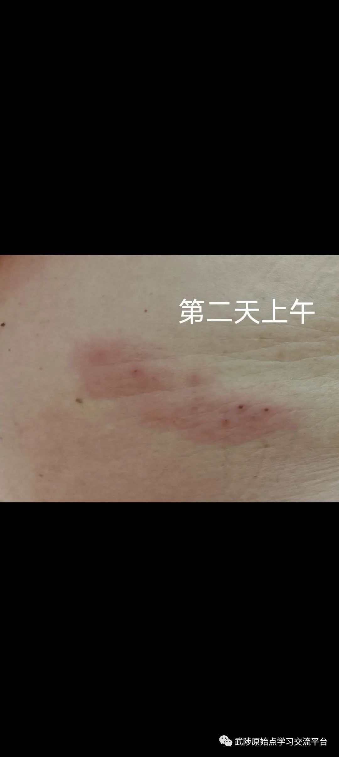 带状疱疹案例 带状疱疹案例