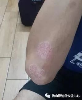 原始点调理九年史牛皮癣:二十天大变化 原始点调理九年史牛皮癣:二十天大变化