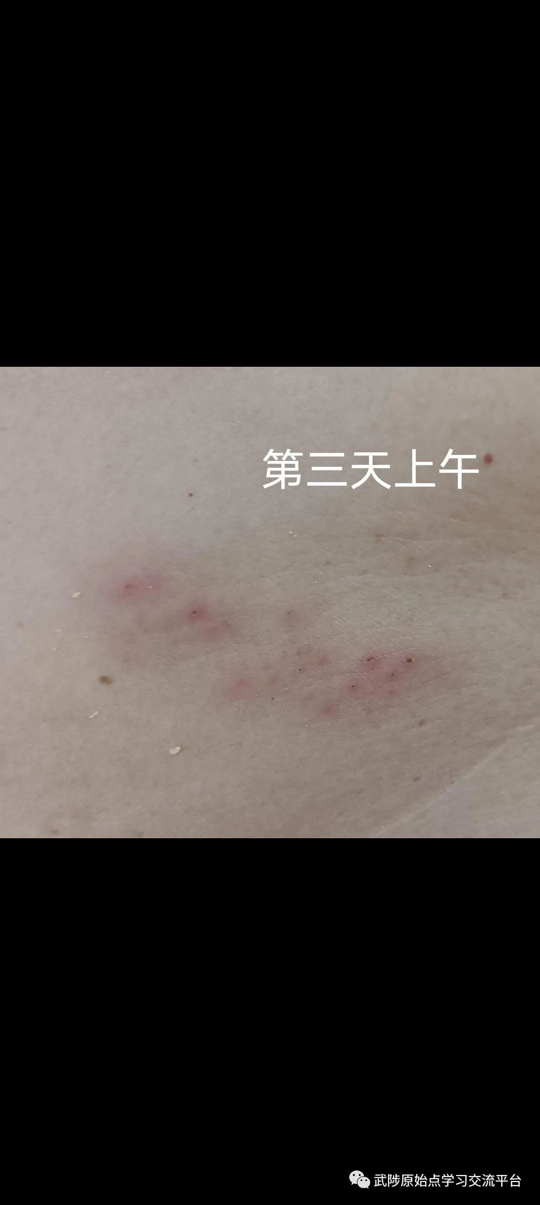 带状疱疹案例 带状疱疹案例